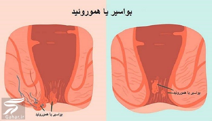 پماد آنتی هموروئید + موارد مصرف و نحوه استفاده