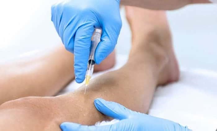 دکتر ضربان؛ چگونه از شر رگ&zwnj;های واریسی خود خلاص شویم؟
