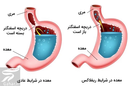 بهترین دارو برای رفلاکس معده (بهترین شربت و قرص رفلاکس)