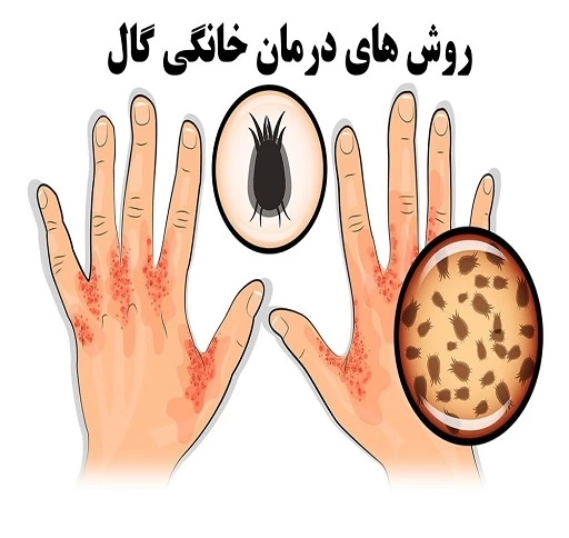 درمان بیماری گال + علایم و درمان گال