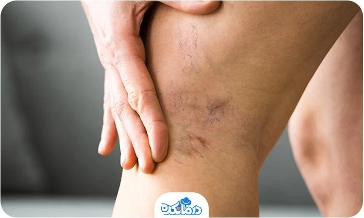 علت پا درد در بارداری چیست؟