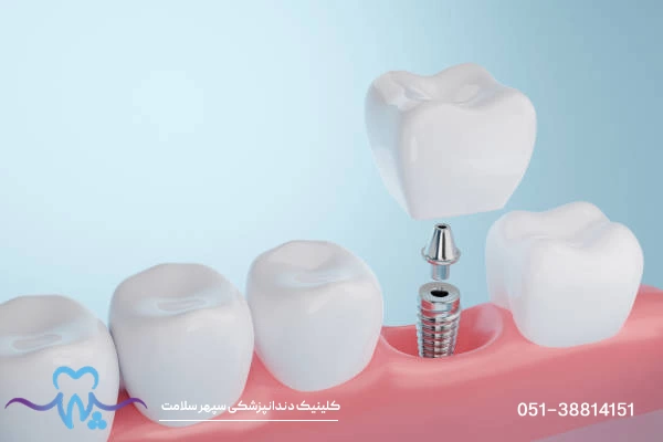 بهترین متخصص ایمپلنت دیجیتال در مشهد