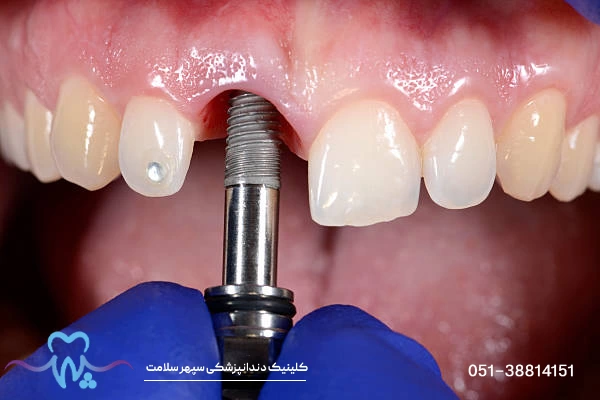 بهترین متخصص ایمپلنت دیجیتال در مشهد