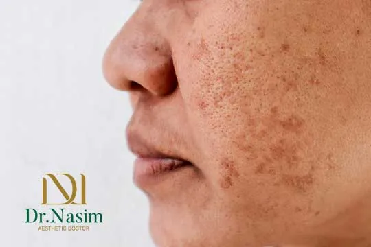 لیزر لک صورت بهتر است یا کرم ضد لک؟ نظر پزشکان خارجی چیست؟