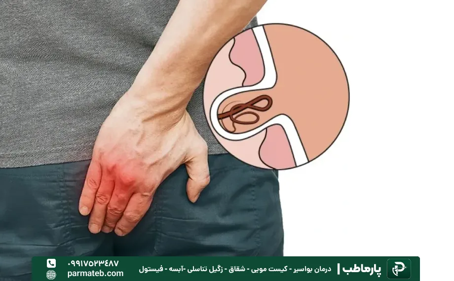درمان اصولی کیست مویی و آبسه مقعدی؛ چرا تجربه پزشک اهمیت دارد؟