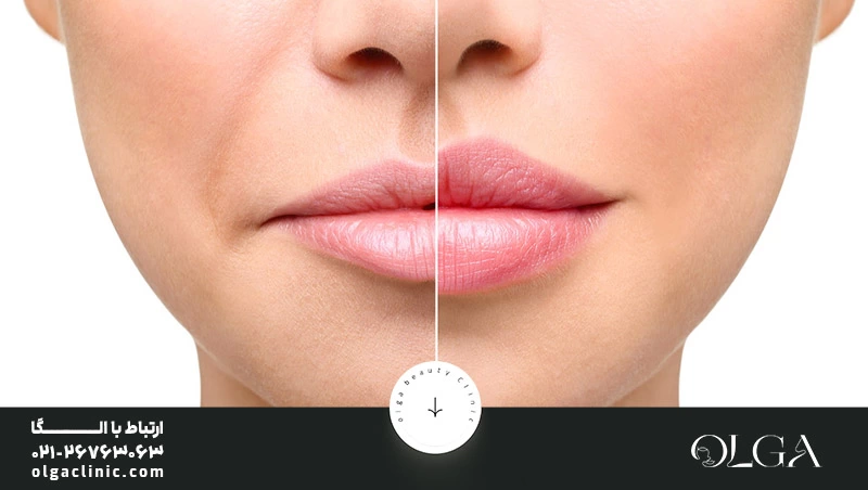 لب روسی چند سی سی ژل لازمه؟