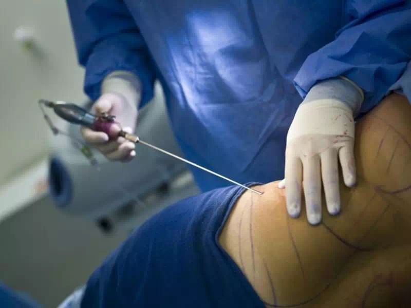 پیکرتراشی چیست و چه کسانی کاندید مناسبی هستند؟